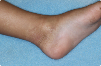 Ankle of clinical trial patient 4 weeks after ZORYVE treatment