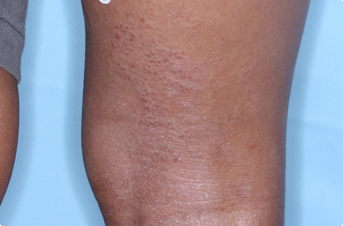 Back of knee of clinical trial patient before starting treatment with ZORYVE