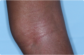 Back of knee of clinical trial patient 1 week after ZORYVE treatment