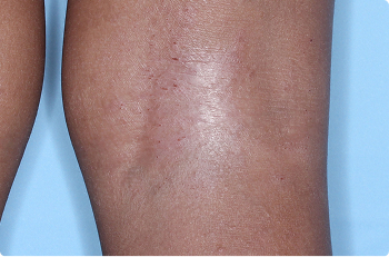 Back of knee of clinical trial patient 4 weeks after ZORYVE treatment