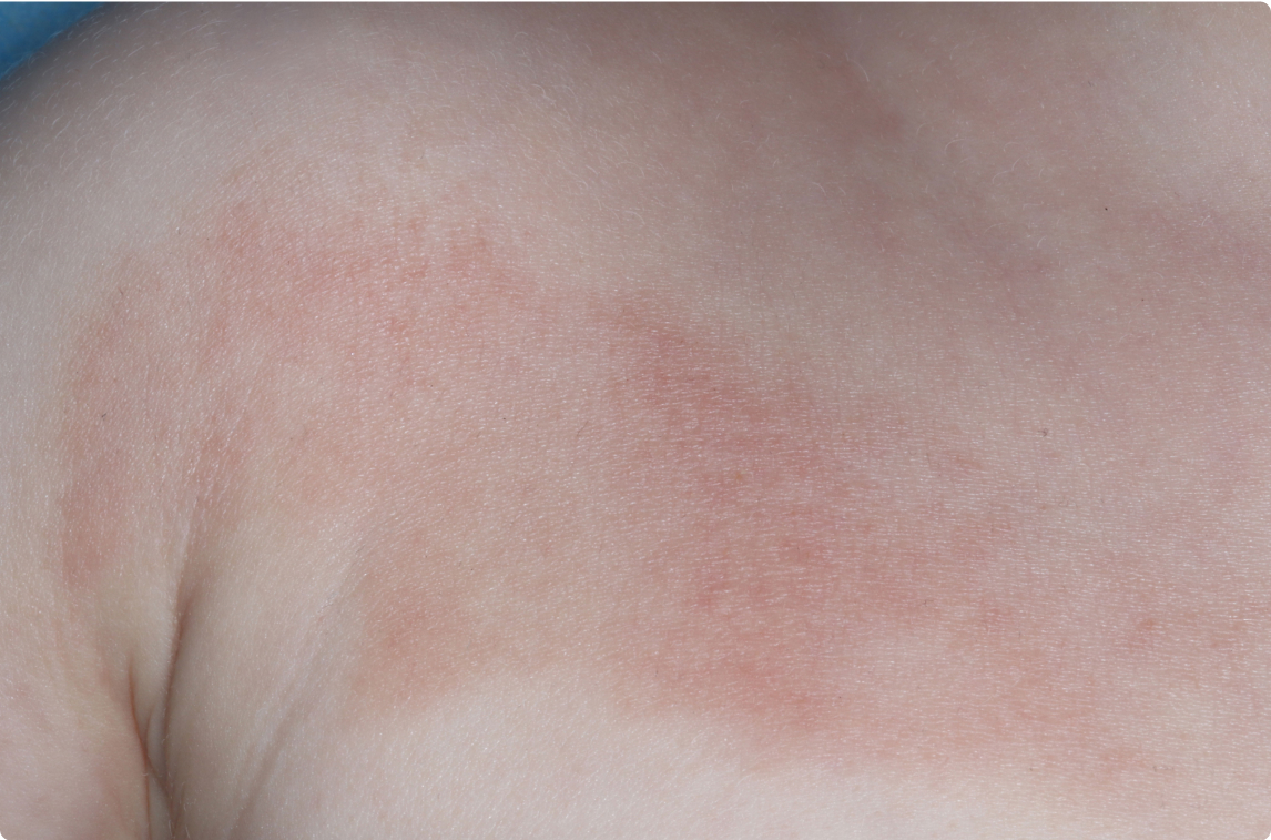 Chest of clinical trial patient before starting treatment with ZORYVE