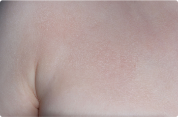 Chest of clinical trial patient 1 week after ZORYVE treatment