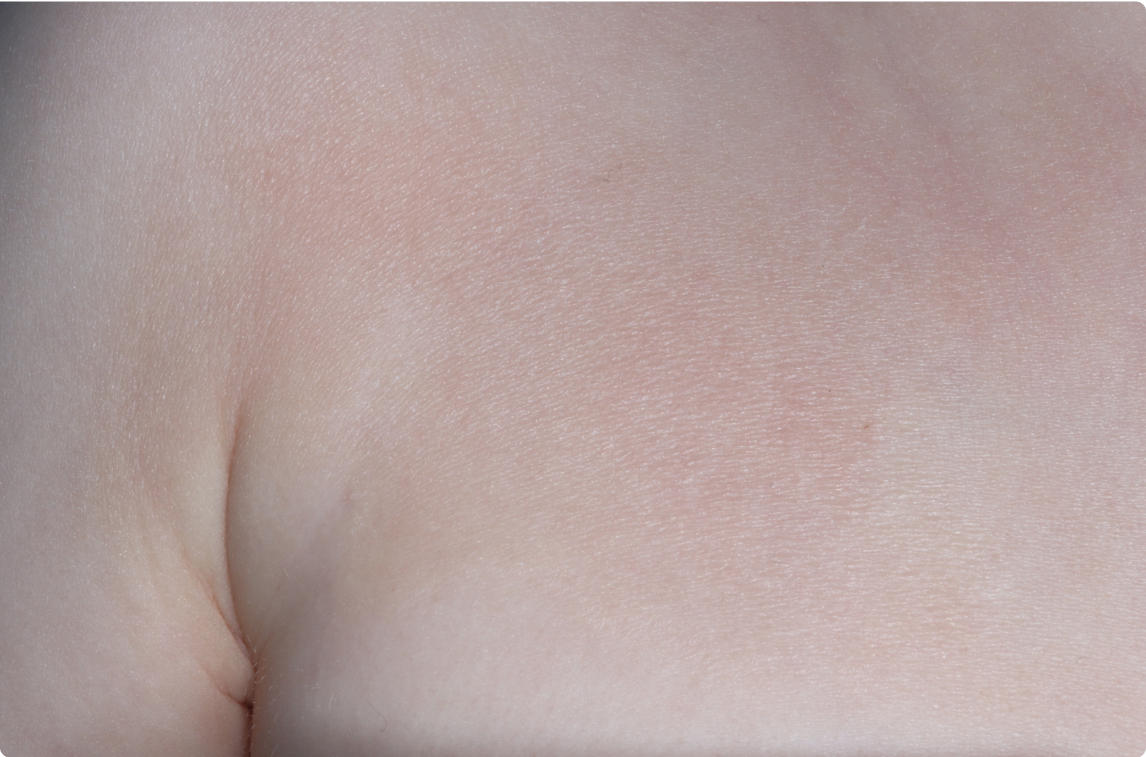 Chest of clinical trial patient 1 week after ZORYVE treatment