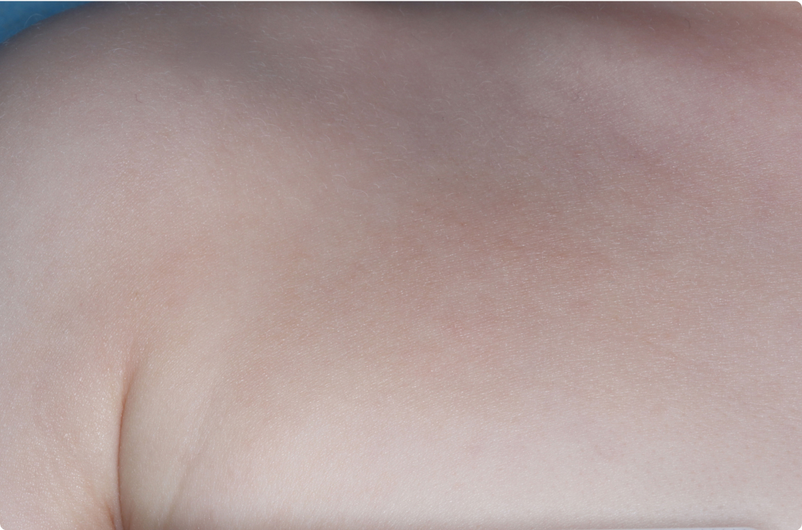 Chest of clinical trial patient 4 weeks after ZORYVE treatment