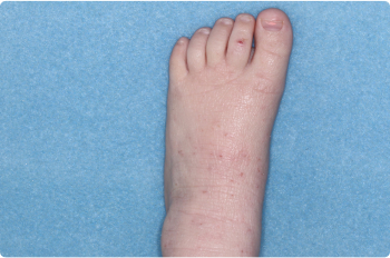 Foot of clinical trial patient before starting treatment with ZORYVE