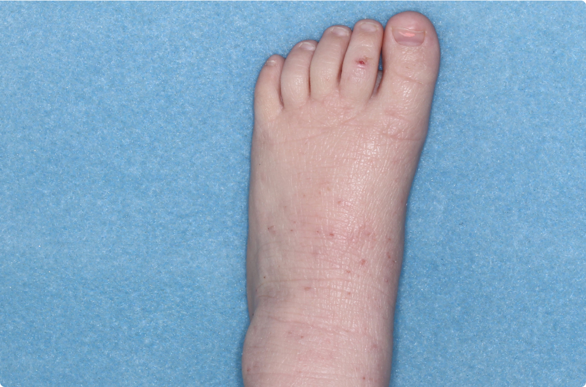 Foot of clinical trial patient before starting treatment with ZORYVE