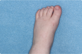Foot of clinical trial patient 1 week after ZORYVE treatment