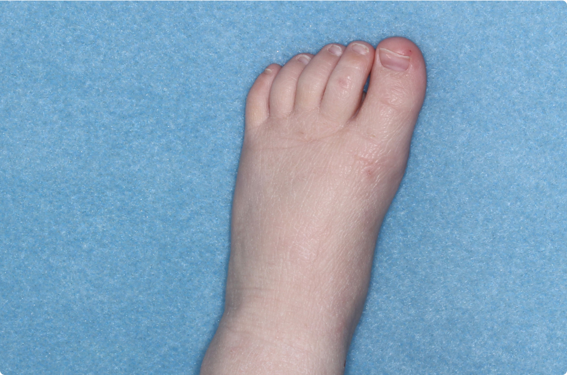 Foot of clinical trial patient 1 week after ZORYVE treatment
