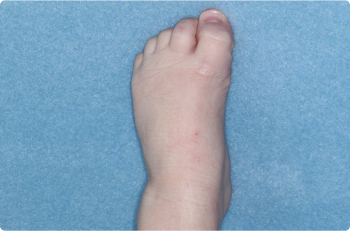 Foot of clinical trial patient 4 weeks after ZORYVE treatment