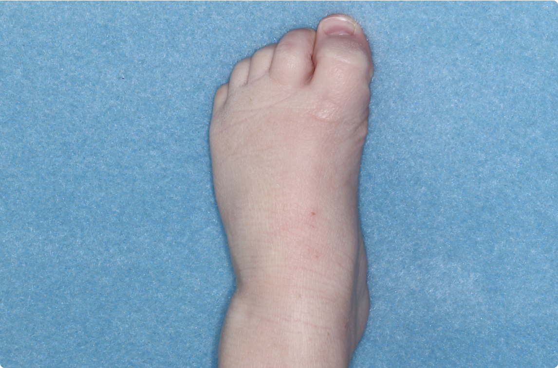 Foot of clinical trial patient 4 weeks after ZORYVE treatment