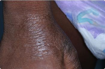 Hand of clinical trial patient before starting treatment with ZORYVE