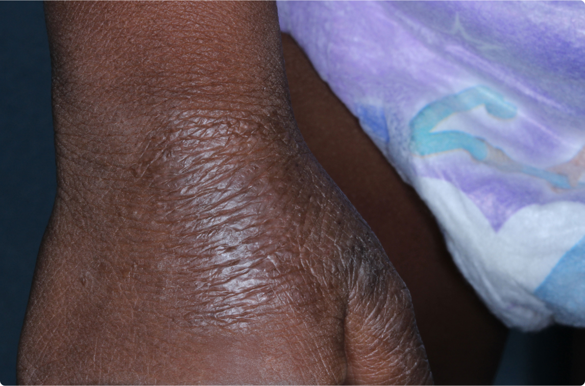 Hand of clinical trial patient before starting treatment with ZORYVE