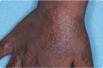 Hand of clinical trial patient 4 weeks after ZORYVE treatment