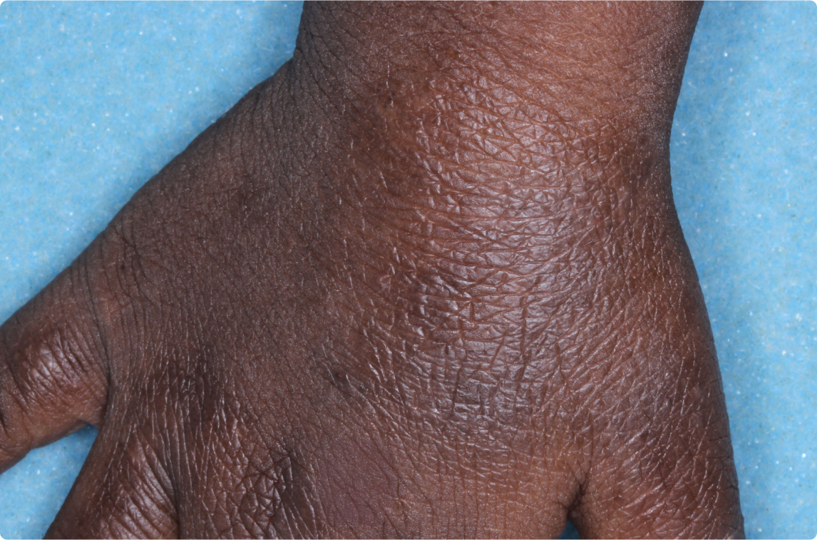 Hand of clinical trial patient 4 weeks after ZORYVE treatment