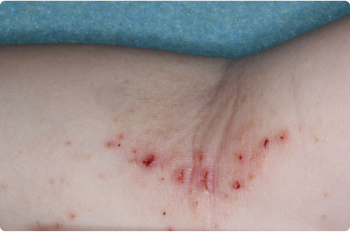 Inside Elbow of clinical trial patient before starting treatment with ZORYVE