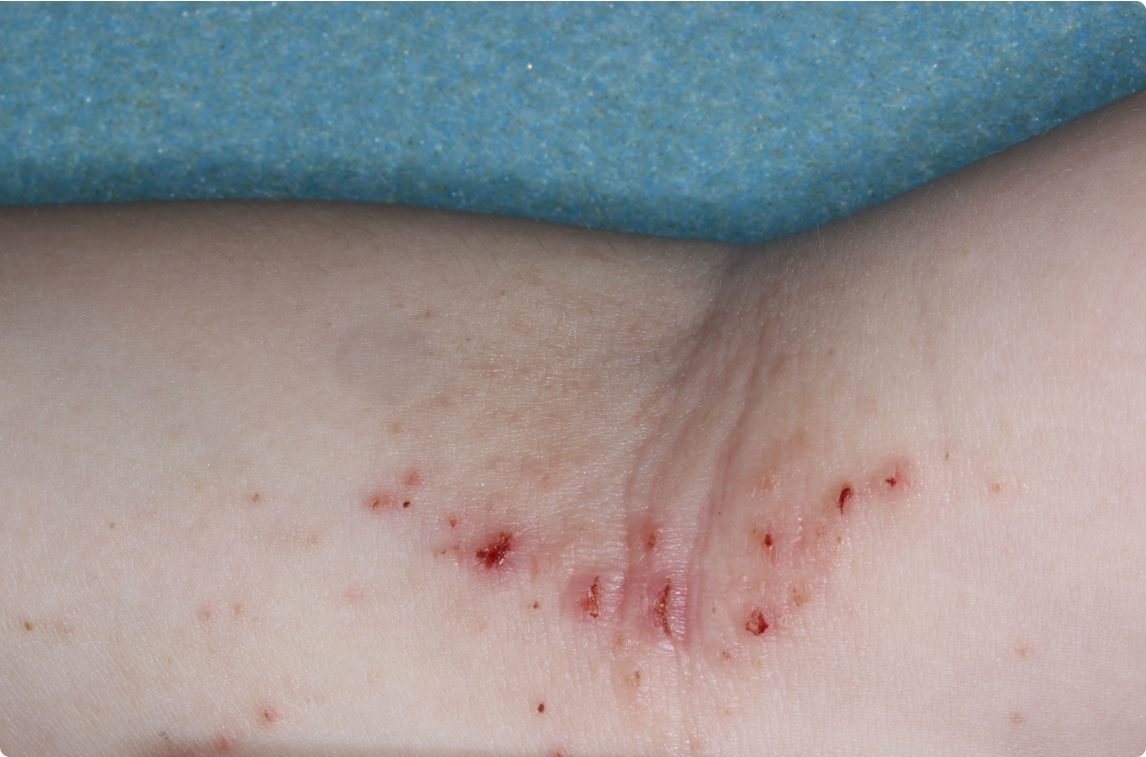 Inside Elbow of clinical trial patient before starting treatment with ZORYVE