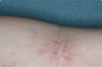 Inside Elbow of clinical trial patient 1 week after ZORYVE treatment
