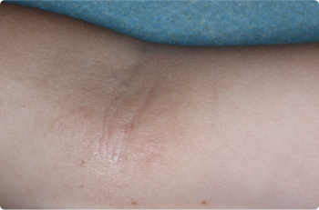 Inside Elbow of clinical trial patient 4 weeks after ZORYVE treatment