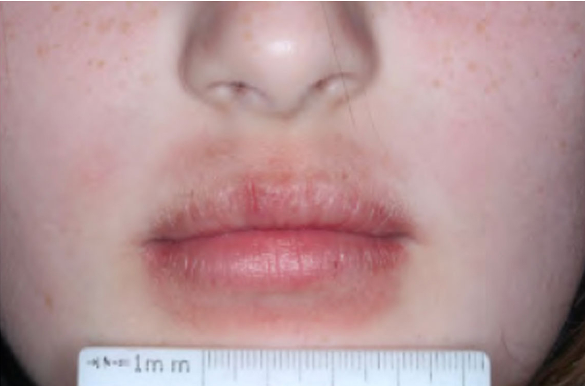Mouth of clinical trial patient before starting treatment with ZORYVE