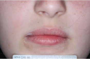Mouth of clinical trial patient 1 week after ZORYVE treatment