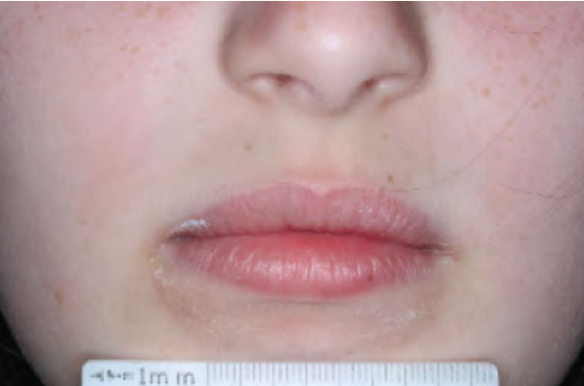 Mouth of clinical trial patient 1 week after ZORYVE treatment