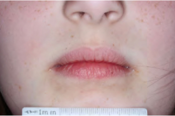 Mouth of clinical trial patient 4 weeks after ZORYVE treatment