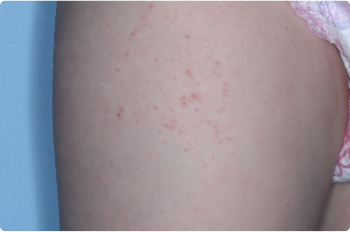 Thigh of clinical trial patient before starting treatment with ZORYVE