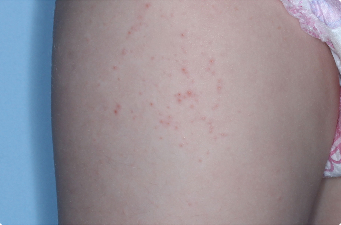 Thigh of clinical trial patient before starting treatment with ZORYVE