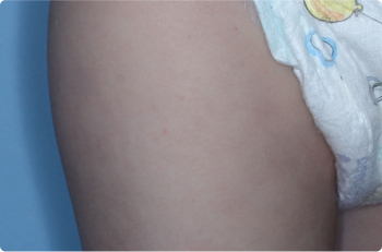 Thigh of clinical trial patient 1 week after ZORYVE treatment