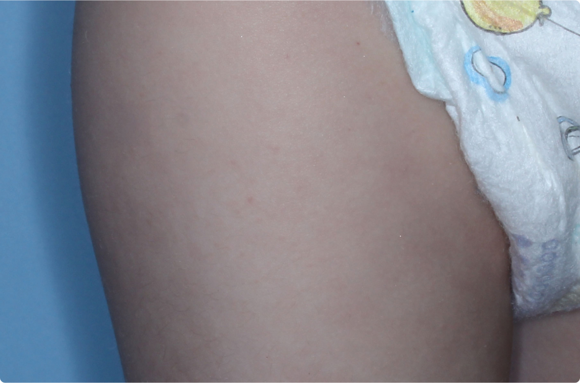 Thigh of clinical trial patient 1 week after ZORYVE treatment