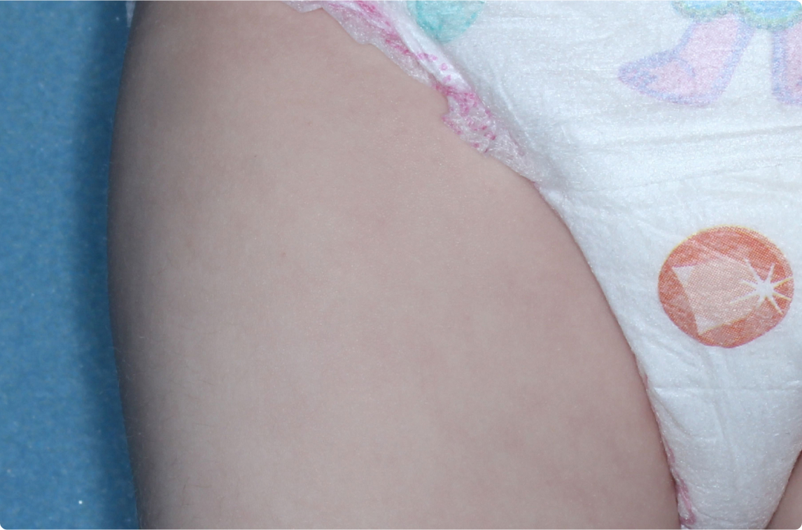 Thigh of clinical trial patient 4 weeks after ZORYVE treatment