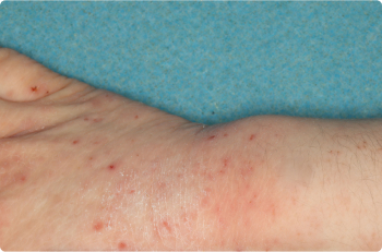 Wrist and Hand of clinical trial patient before starting treatment with ZORYVE