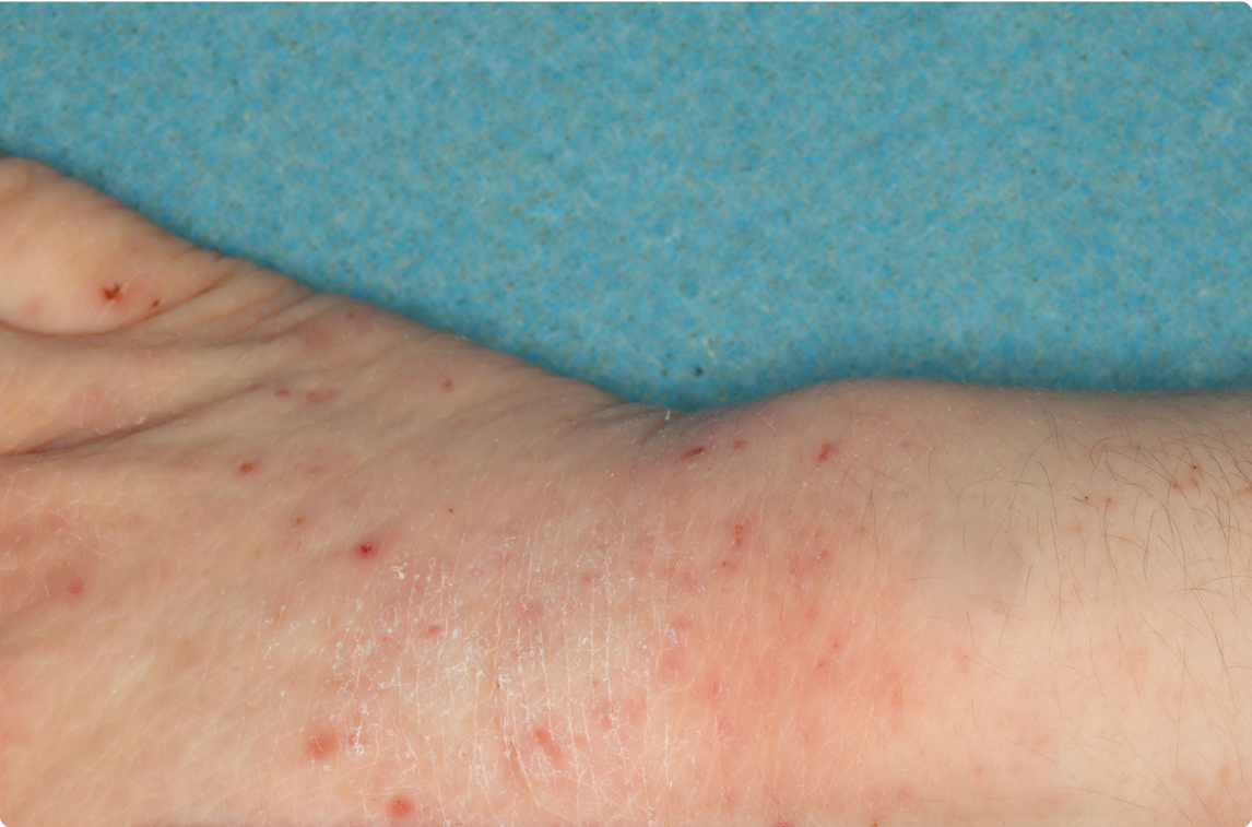 Wrist and Hand of clinical trial patient before starting treatment with ZORYVE