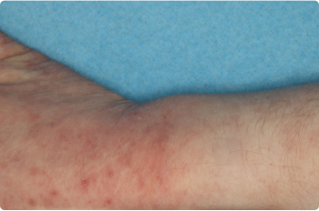 Wrist and Hand of clinical trial patient 1 week after ZORYVE treatment