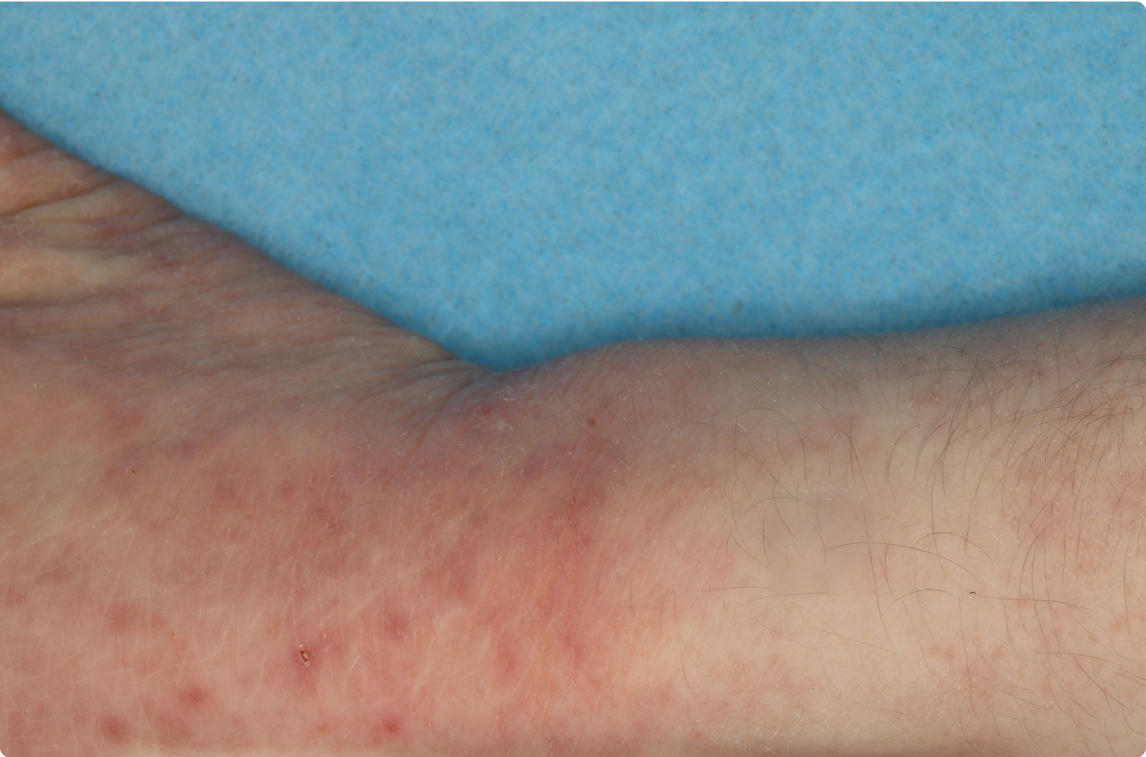 Wrist and Hand of clinical trial patient 1 week after ZORYVE treatment