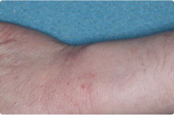 Wrist and Hand of clinical trial patient 4 weeks after ZORYVE treatment