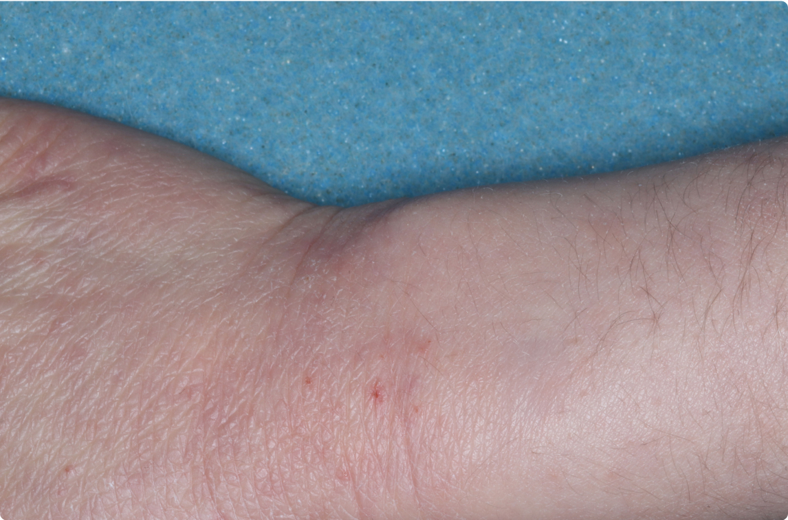 Wrist and Hand of clinical trial patient 4 weeks after ZORYVE treatment